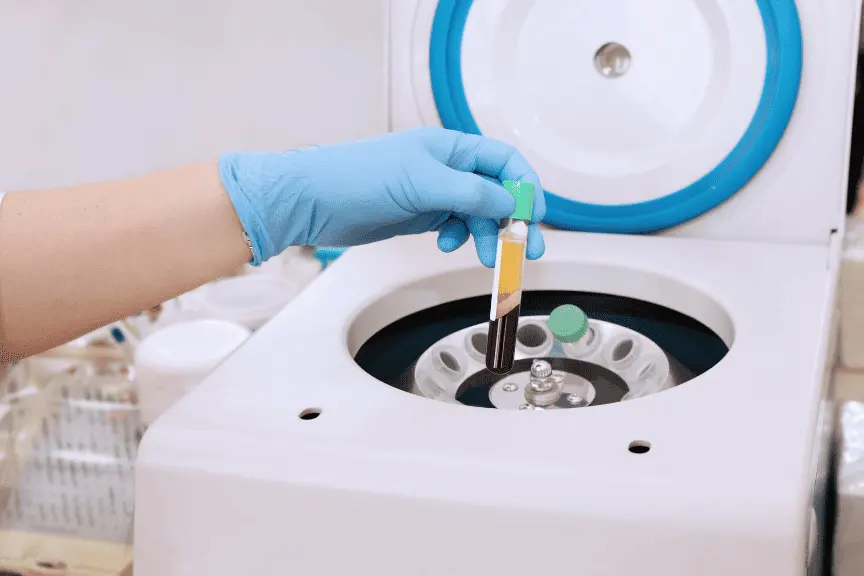 A blood sample spun down in a centrifuge to isolate regenerative factors